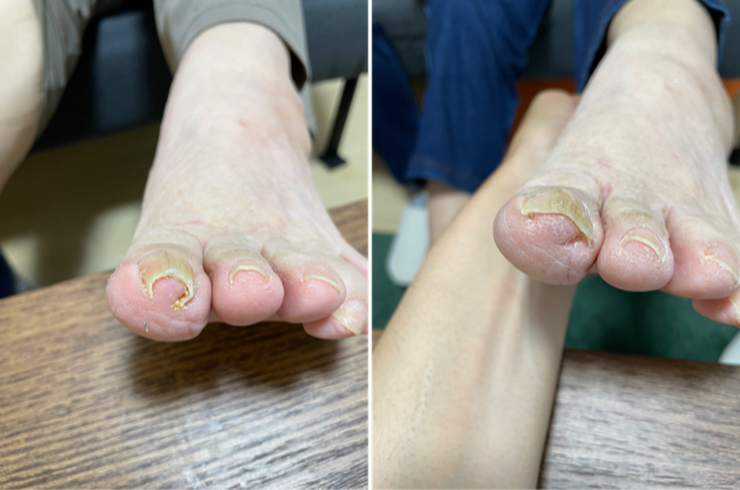 浅野さん左足ビフォーアフター